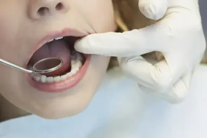 “Ağrısı yok” demeyin! Diş çürükleri böyle fark edilmeden büyüyor